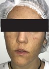 How I Do It - Acne before treatment