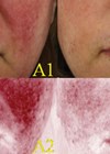 Before and after - clinical and erythema-directed photography 1